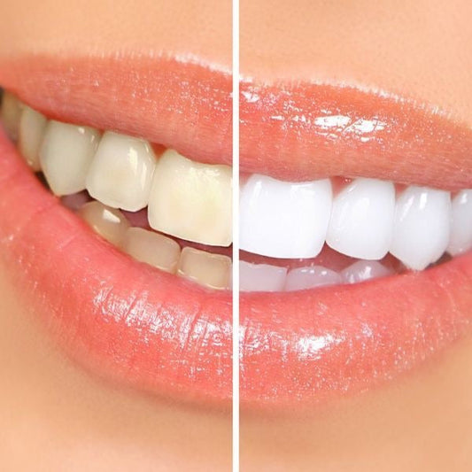 Why an Electric Toothbrush is More Effective Than a Manual Toothbrush